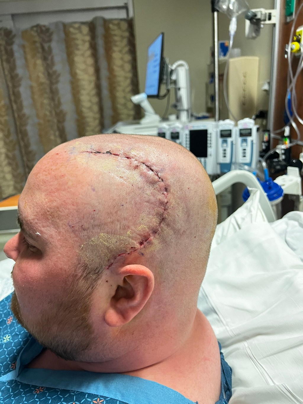 One Step Forward and Three Steps Back